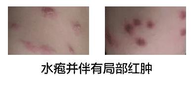 7种皮肤病又红又痒积水潭医生教你对图自查