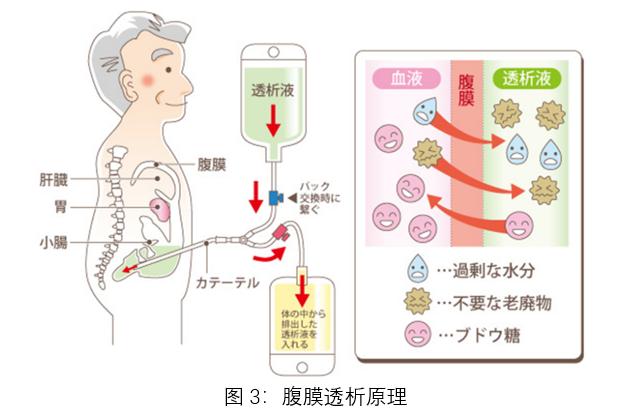 其原理与血液透析类似,只是将腹膜作为透析器,通过置入在腹壁上的管路