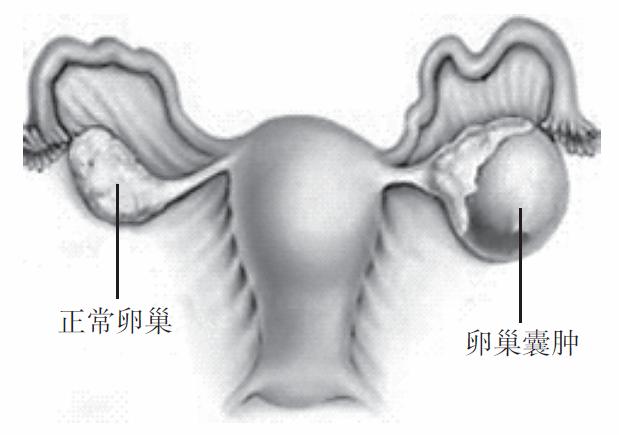 怎么就得了卵巢囊肿向女性朋友们解答卵巢囊肿的常见问题