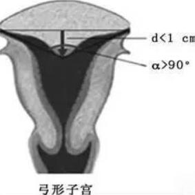 弓形子宫的宫腔相对完整,而双子宫被认为是两个正常子宫的组合,一般