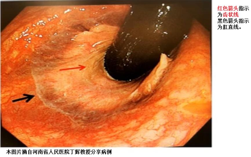 图1:齿状线的位置(直肠内面观)二,齿状线的位置及意义在讨论内镜下痔