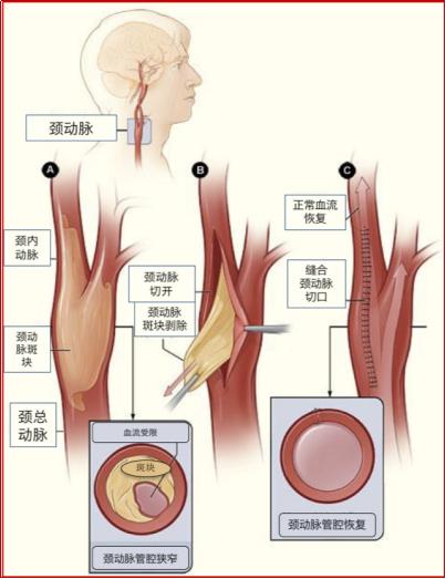 【大家问】颈动脉,椎动脉里有斑块,是不是离脑梗不远了?