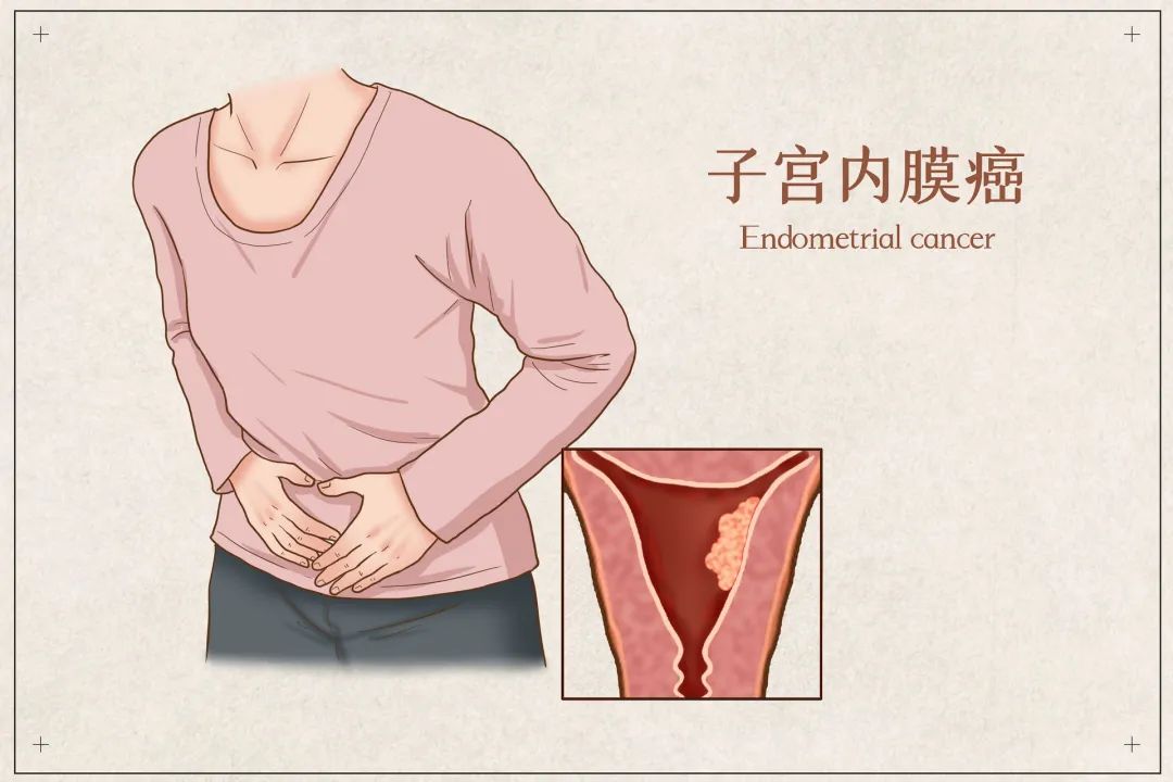 月经不调,月经淋漓不尽,当心是这种恶性肿瘤作祟