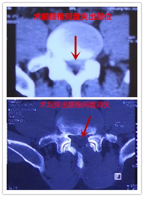 1厘米小切口治疗腰椎间盘突出,总医院此项技术地区领先