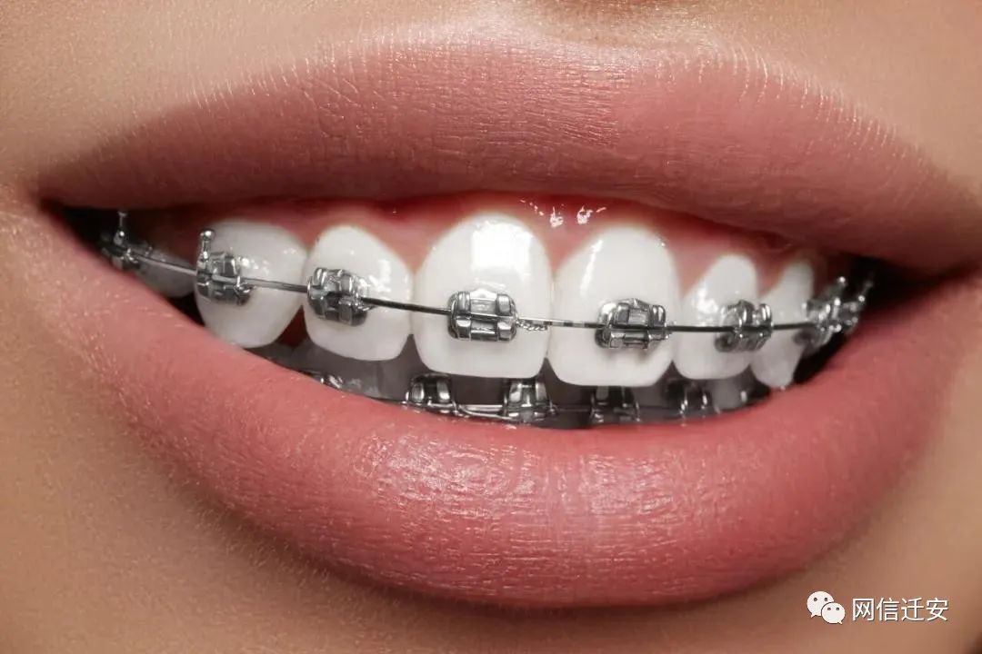 【网络谣言粉碎机】流言:牙齿不整齐应该带牙套,会变美