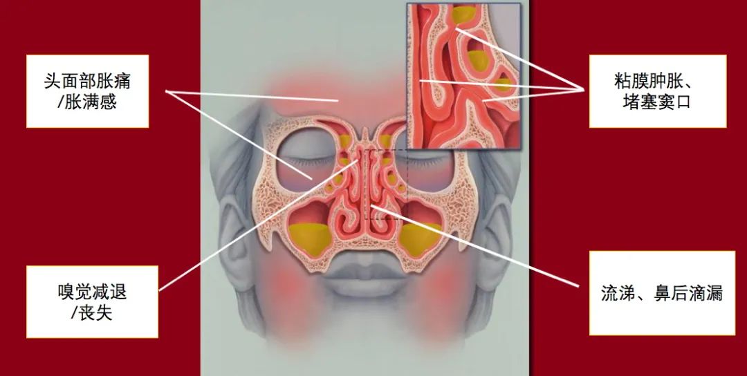 慢性鼻窦炎的鼻内镜微创治疗