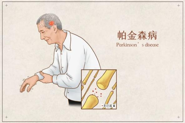 1 搓丸样震颤 是用来形容帕金森病患者手抖的样子的,即拇指与屈曲的