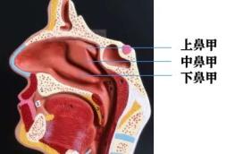 鼻炎还是鼻窦炎?傻傻分不清