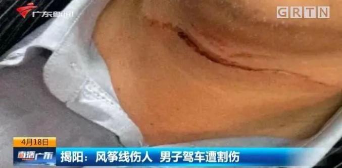 脖子也受了伤摩托头盔的系绳被风筝线割断在骑摩托车回家的路上广东
