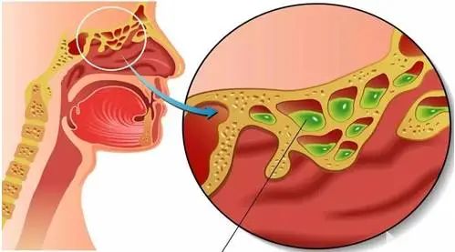 怎么知道自己得了鼻窦炎?视频带你探秘慢性鼻窦炎的诊治