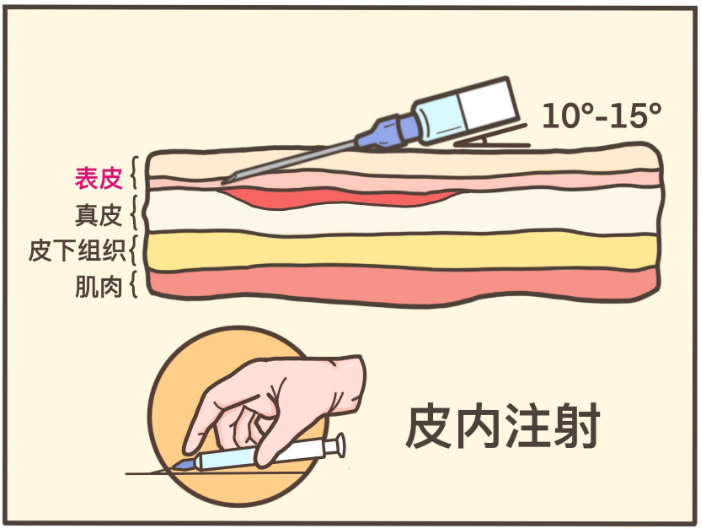 请回想一下打青霉素前做的「皮试」,你将迅速理解这种打法的痛.