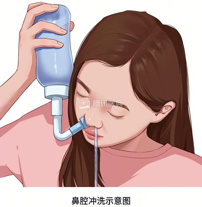 洗鼻是俗称,在医学上叫做鼻冲洗(鼻腔冲洗).