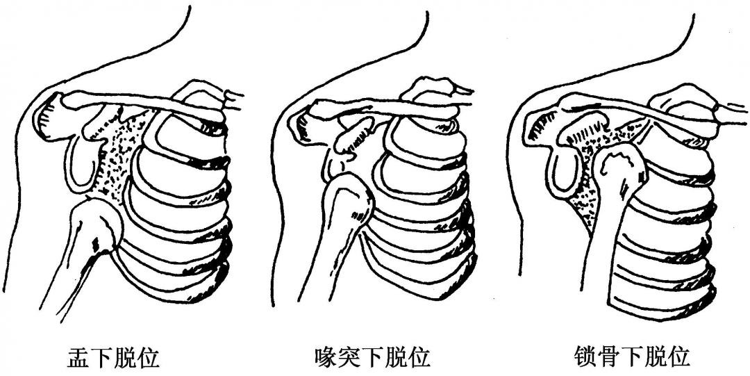 检查时可发现患肩呈方肩畸形,患肩失去正常饱满圆钝的外形呈"方肩"样