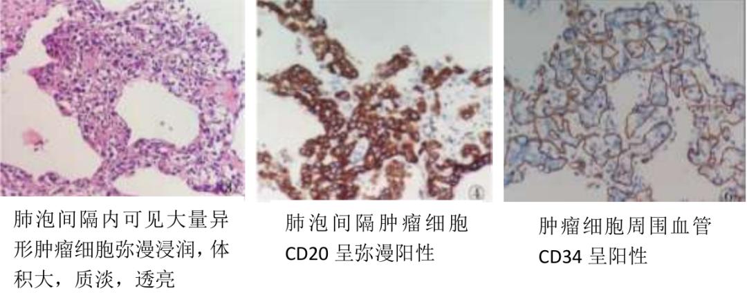 反复发热伴双肺弥漫性磨玻璃影,这么抗感染无用