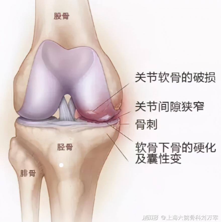 截骨保膝手术知多少?