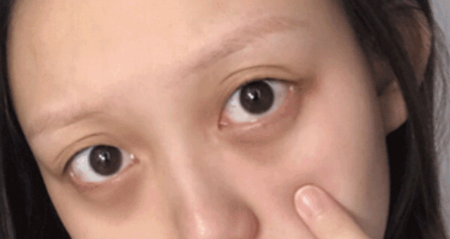 黑眼圈一直消不了?不是没睡好,可能是它在作怪!