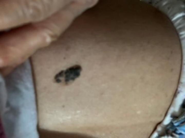 医生看了一眼这个"痣",就说是肝癌信号?快看看自己身上有没有!
