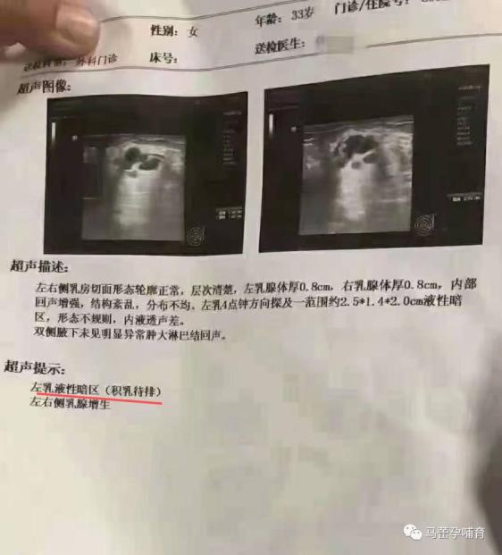 断奶8个月,b超单提示积乳待排