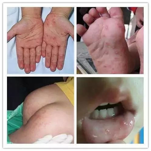 典型症状:斑丘疹,疱疹,疱疹周围有炎性红晕,疱内液体较少,不疼不痒
