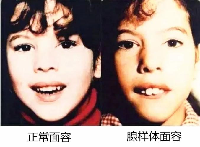 的睡眠张口呼吸打呼噜 会引起面颅发育变形 就是俗称的"腺样体面容"