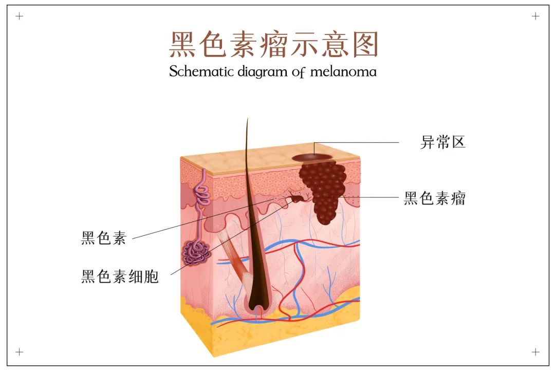 身上的"黑点点"是痣还是黑色素瘤?