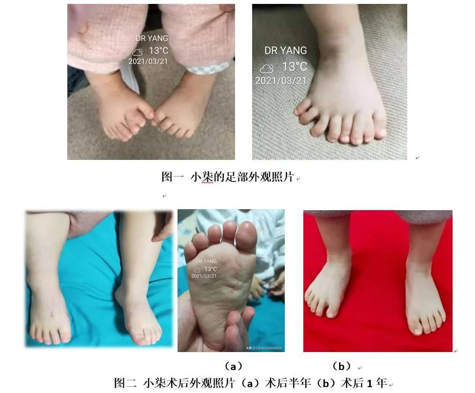 一岁幼儿右脚8个脚趾,多趾畸形的小宝贝,到底该什么