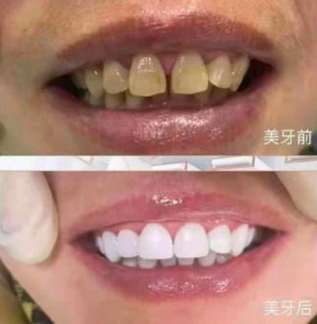 美白牙齿骗局还要坑多少人