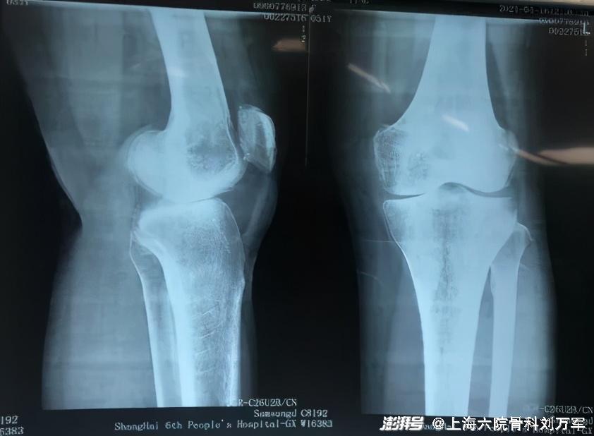 膝关节单髁置换术,关节置换不再"一刀切"