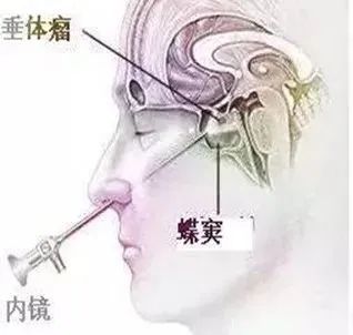 鑫医话健康垂体瘤是什么瘤带您一起走进它