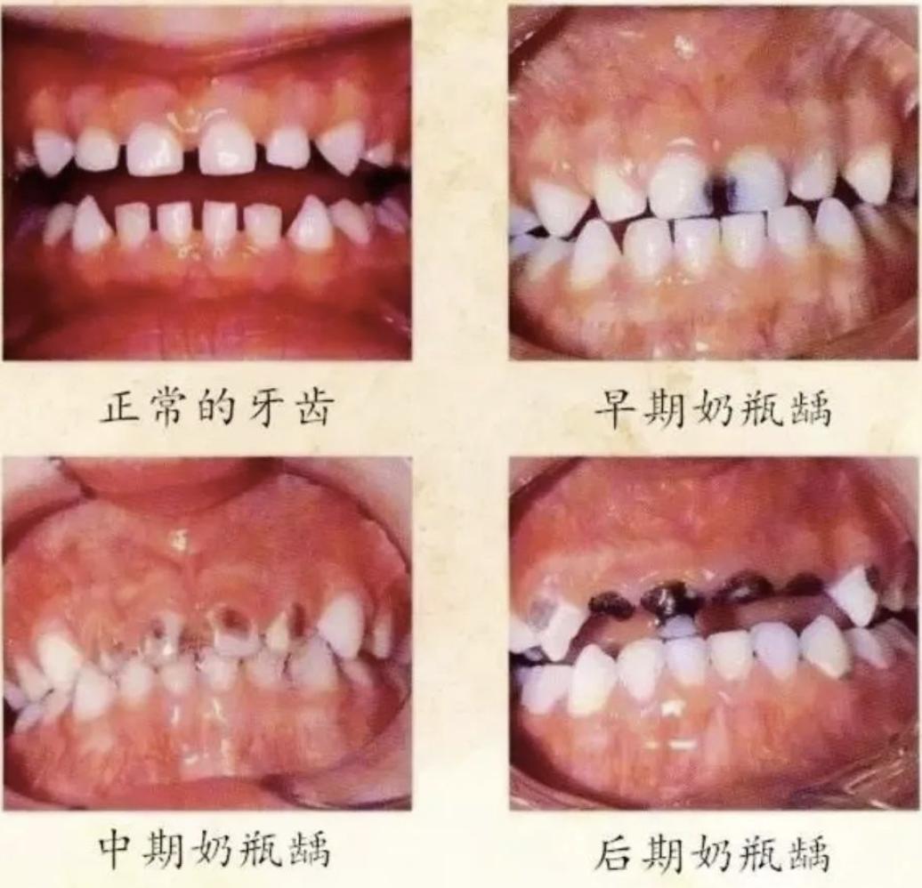 或是安抚奶嘴,不仅会增加口腔内的细菌感染,还会引起宝宝牙齿和上颌骨