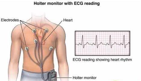 医声相伴崔松说 (24/72小时holter或者更长时间) 优点:检查时间长,有