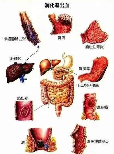 健康星期天带你认识消化道出血