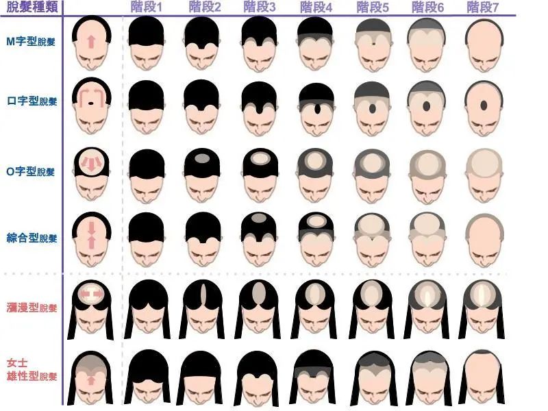 发型很多最常见脱发原因1青年早秃为什么偏偏是你还是挡不住家里到处