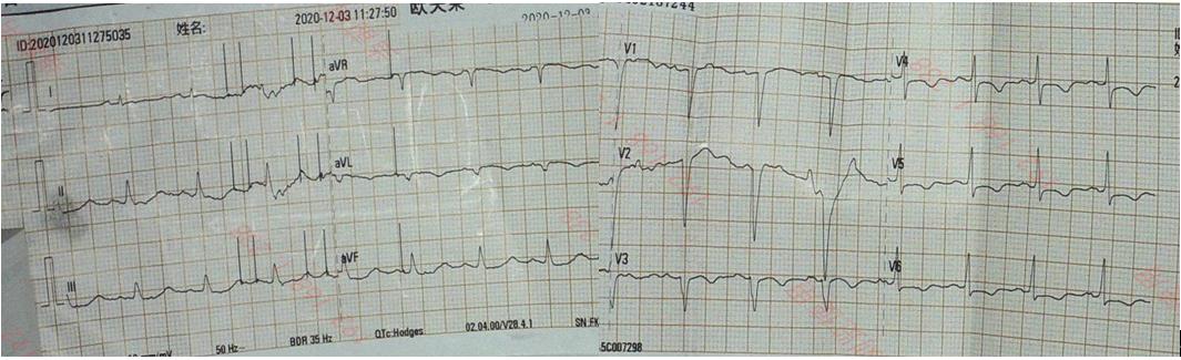 心电图:窦性心律 100 bpm,v1-3 病理性q波,v4-6 st段压低0.