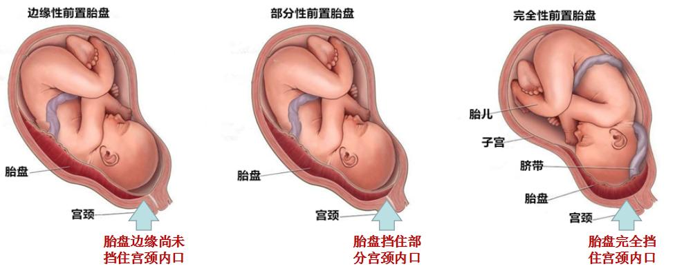 如果胎盘下缘和宫颈内口的距离大于2cm,恭喜你,获得了一个优秀的正常