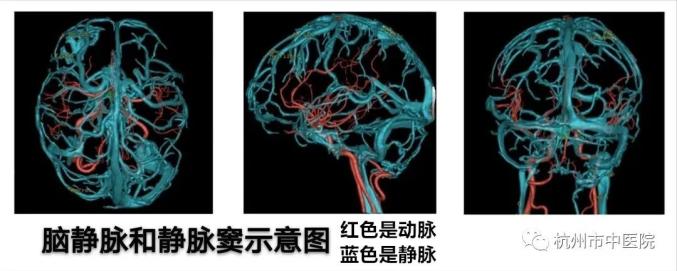 颅内静脉系统血栓,又称为脑静脉窦血栓,是由多种病因所导致的以脑静脉