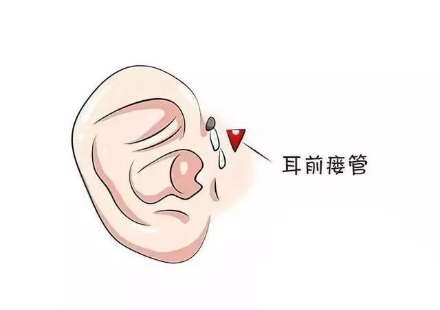 上海市奉贤区中心医院 27岁的张先生自出生时 左耳前就有一个小洞眼