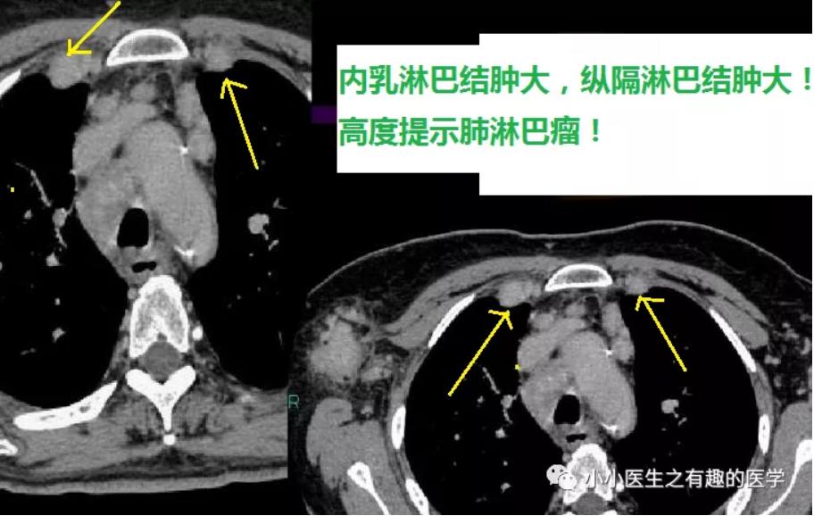 呈实变或结节,肿块,有空气支气管征,腋窝淋巴结肿大,内乳淋巴结肿大