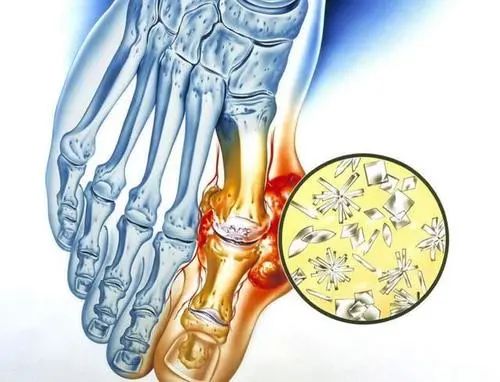 痛风石能手术吗