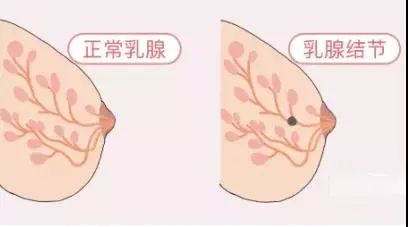 解密乳腺病的四大金刚守护女性的天生之美