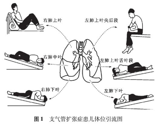 反复咳嗽咯痰警惕儿童支气管扩张症