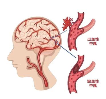 出血性脑卒中:发病时症状比较突出,例如:突然头痛,呕吐,昏迷.