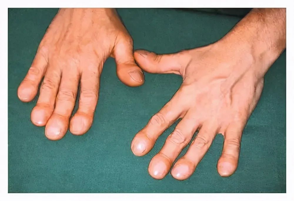 手指关节肿胀可能是肺癌惹的祸