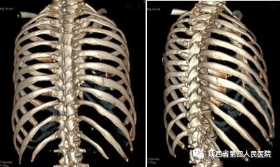 多层螺旋ct三维重建影像检查肋骨骨折必不可少