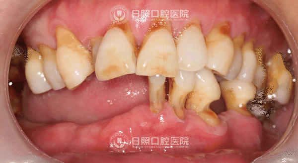 数月前,老刘下颌仅剩的5颗牙齿也出现松动,严重影响了正常咀嚼,让他