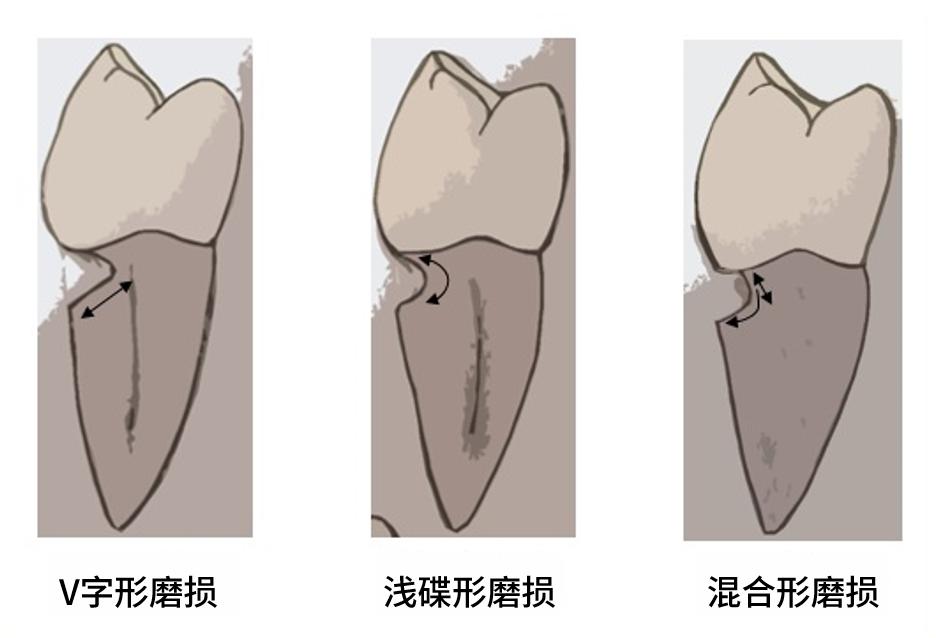 涨知识牙颈部位有豁口小心楔状缺损把牙齿送上断头台
