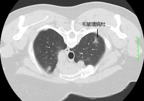 澎湃号>百色市人民医院> 肺部毛玻璃结节简称磨玻璃结节,指的是ct可见