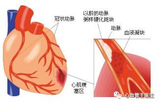 心肌缺血有哪些表现?