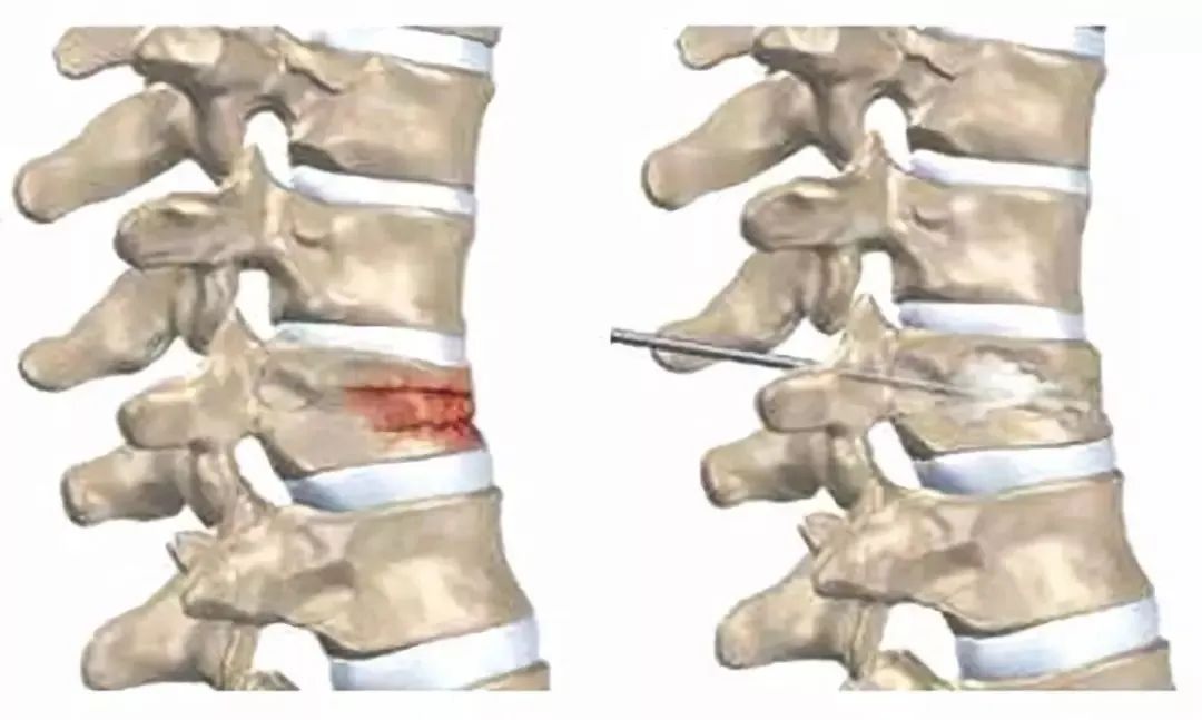 小舍得骨质疏松性椎体压缩性骨折怎么治