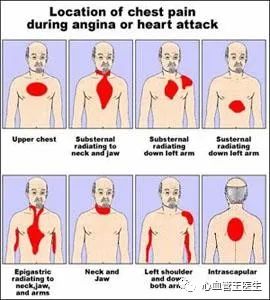 心血管王医生 1,必须明确:心绞痛觉不仅仅是心前区疼痛,心绞痛的部位